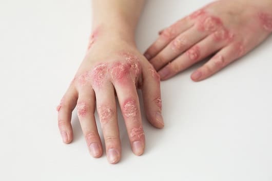 Sun Pharma Psoriasis 1.11