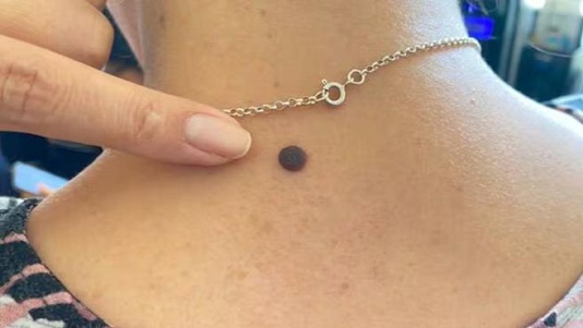 Minsa recomienda detectar a tiempo lunares sospechosos para prevenir cáncer de piel 1 1345050 minsa recomienda la deteccion temprana de lunares sospechosos para descartar cancer de piel2