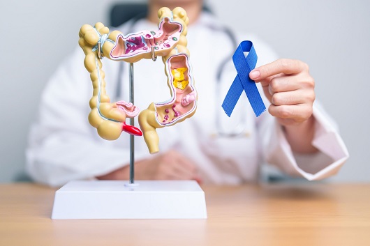 Cáncer de colon: cuatro claves para prevenirlo 1 cancer de colon