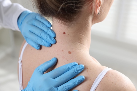 Síntomas de alerta del cáncer de piel en lunares 1 SM Lunares1