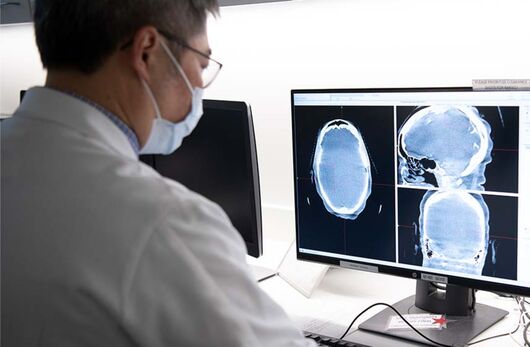 Meningioma el tumor cerebral más común en adultos 1 Tumor Cleveland Clinic1