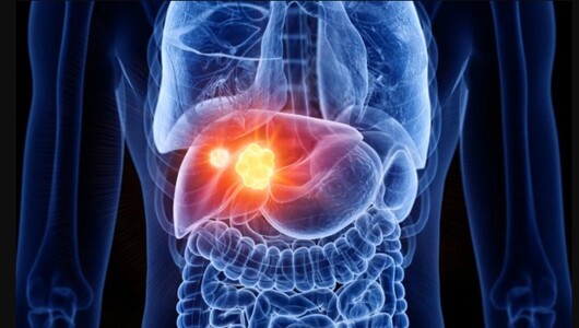 Hepatitis B y el riesgo de desarrollar cáncer de hígado 1 cance de higado1
